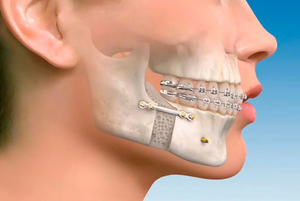 5 Tipos de cirugía maxilofacial más comunes y sus objetivos