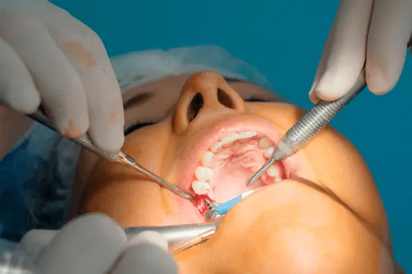 Cómo es el procedimiento de una endodoncia