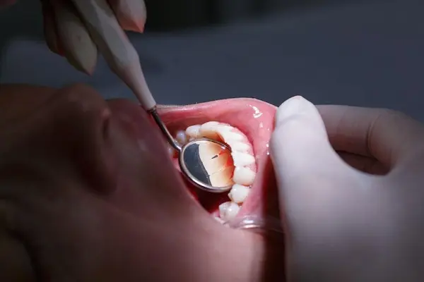 Cuándo una endodoncia no funciona