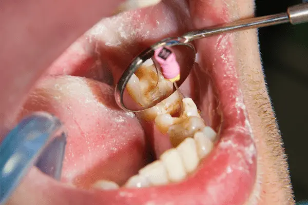 Qué pasa si no te haces una endodoncia a tiempo