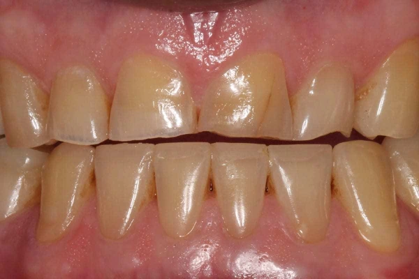 ¿Cómo se forma la placa bacteriana en la boca?